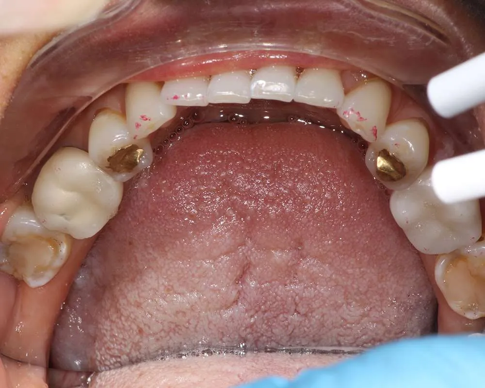 Photo of before lowers denture