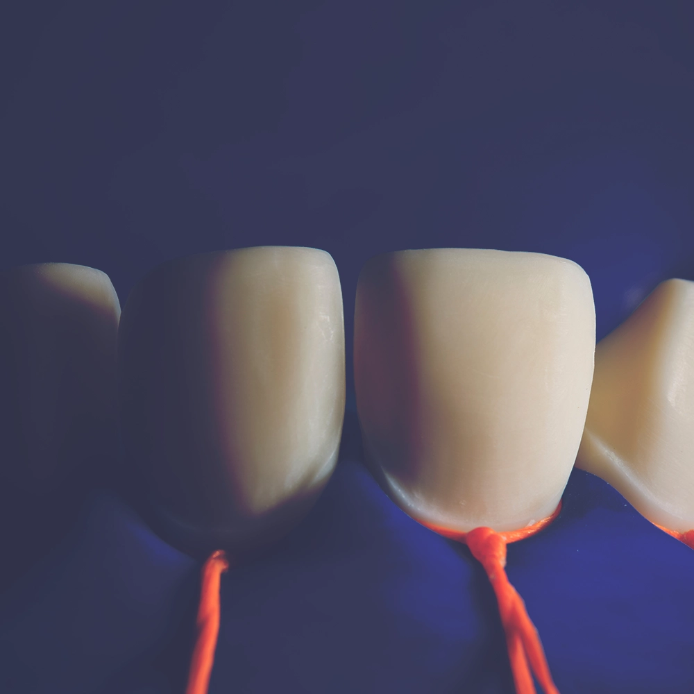 Close-up of three dental veneers attached to teeth, with orange retraction cords around the gums, prepared for fitting, showcasing the aesthetic and functional aspects of veneer application.