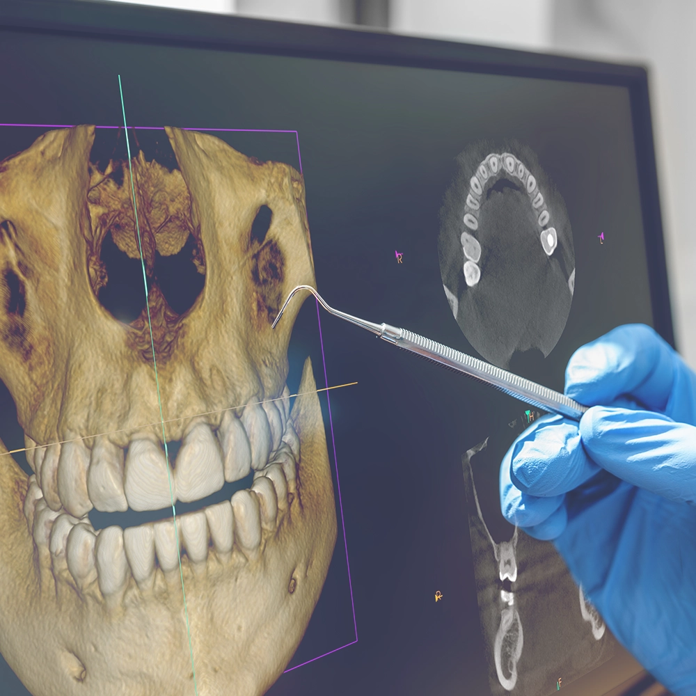 A dentist wearing gloves uses a dental probe to analyze a 3D scan of a patient's skull and teeth displayed on a monitor, focusing on detailed dental imaging for complex case planning.