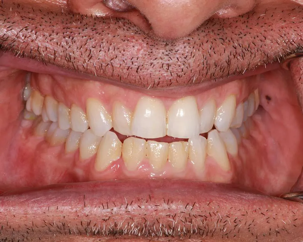 Photo of before retracted denture