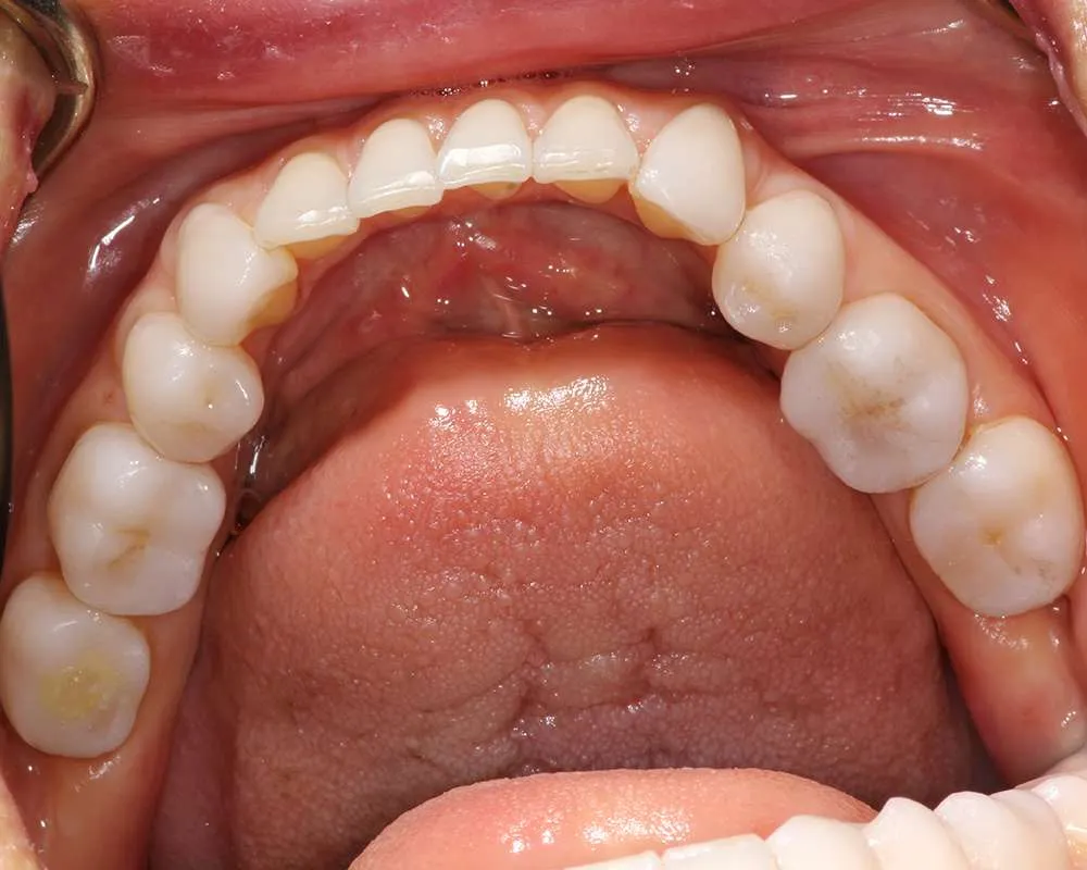 Photo of after lower denture