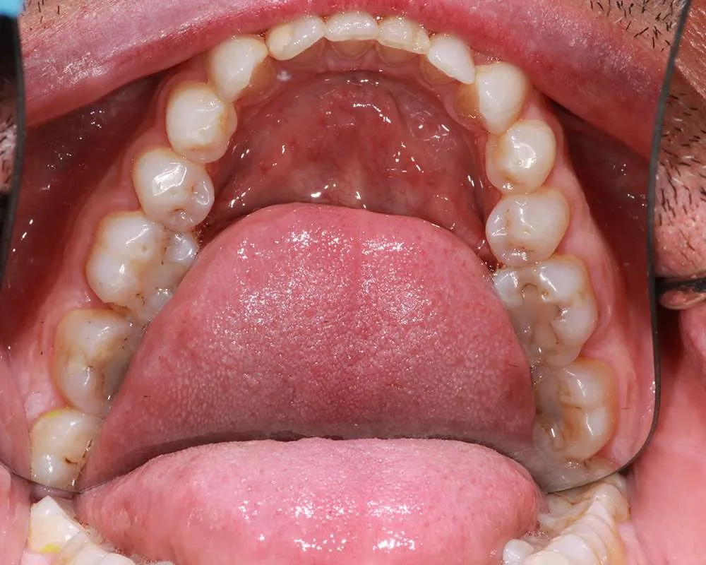 Photo of before lower denture