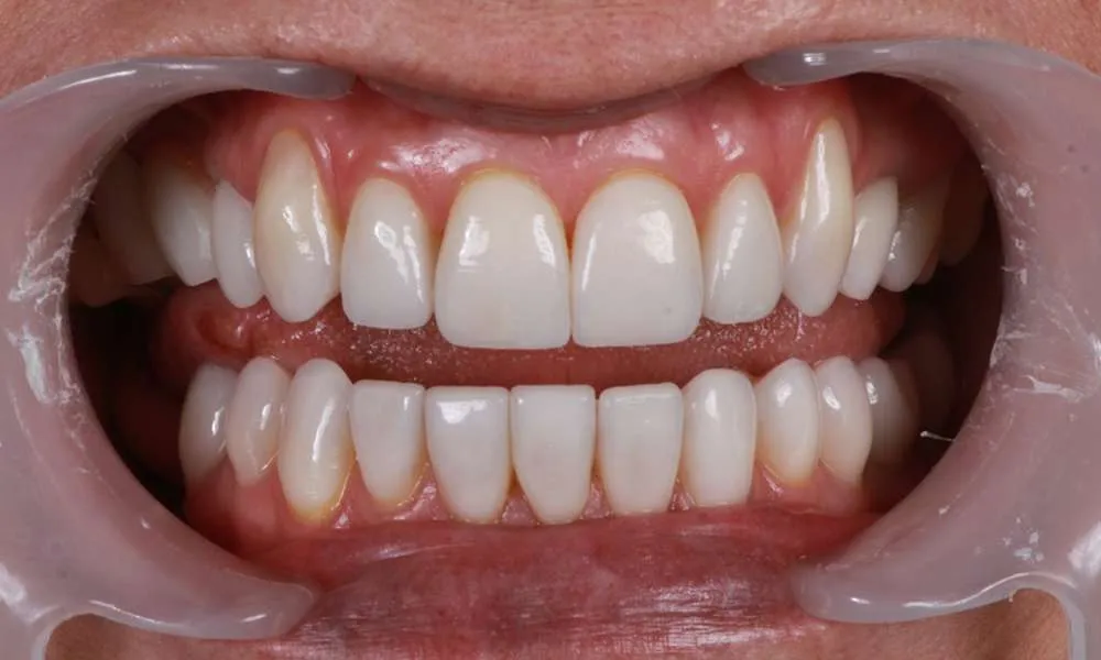 Photo of after retracted denture