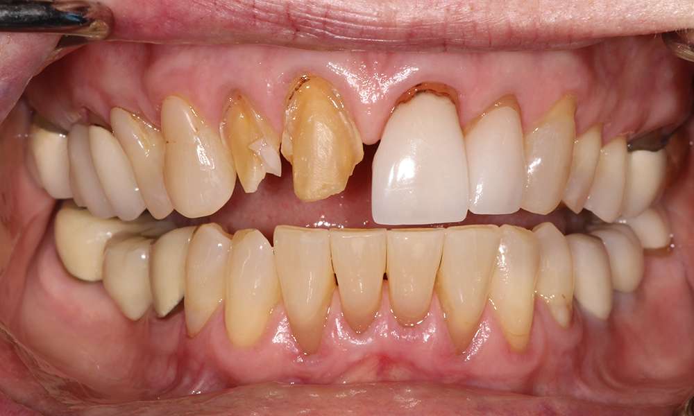 Bio mimetic dentistry full mouth reconstruction before of a old lady