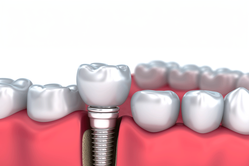Medically accurate 3D illustration of a Dental Implant.